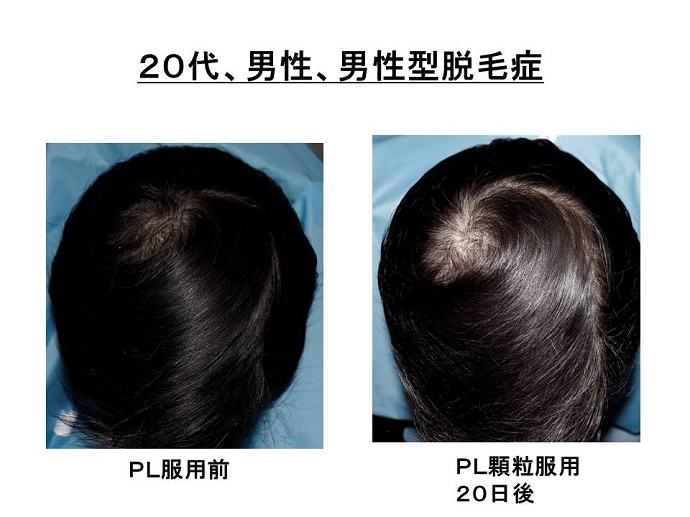 円形脱毛症　病院